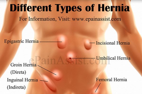 Different Types of Hernia