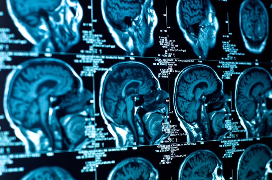 Brain MRI Scan