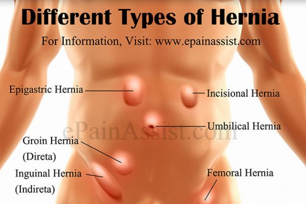 different-types-of-hernia